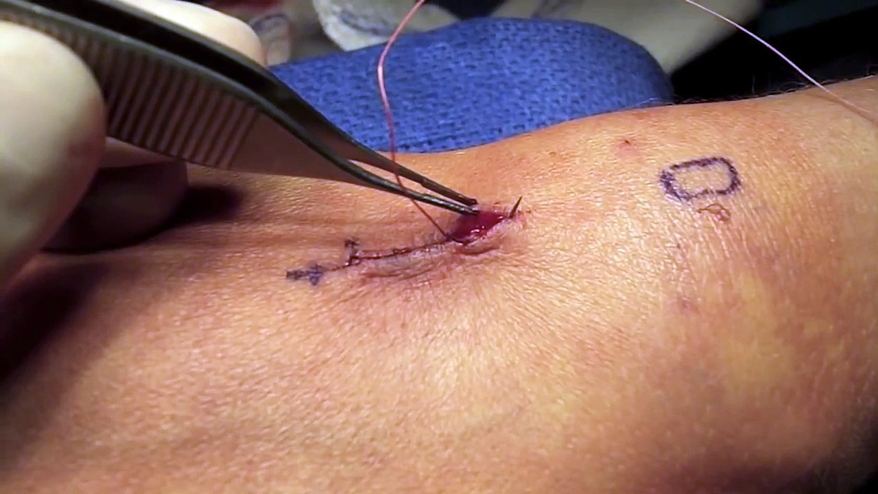 Subcuticular Suture Technique - Hand and Arm Surgery