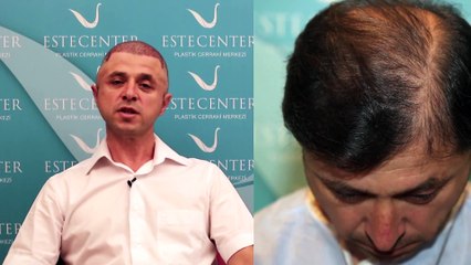 Saç Ektiren Hasta Yorumları - Göktürk Kaya