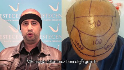 Saç Ektiren Hasta Yorumları - Mehdi İdris