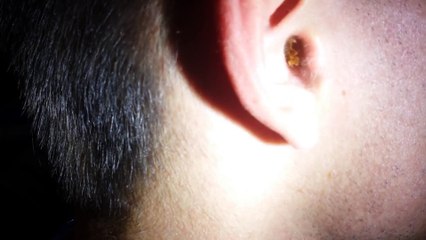 Lui il a les oreilles très sales! Gros paquet de cire retiré