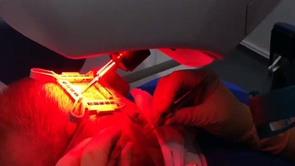 Intervention de prélèvement de cheveux en vue d'une greffe par le Dr Aharoni