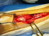Intervento chirurgico di ricostruzione del tendine d'achille