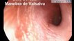 Otite Média Serosa- Videotosocopia com Manobra de Valsalva\ Otoendoscopy in Serous Otitis Media