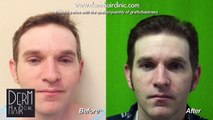 FUE hair transplant for hairline and crown
