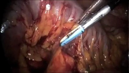 Dissection of Inferior Mesenteric Artery with the Ligasure Advance