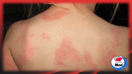 Remedios caseros para la urticaria