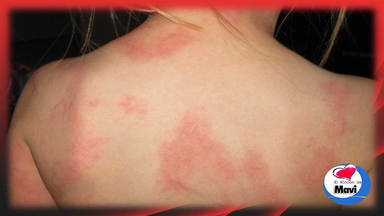 Remedios caseros para la urticaria