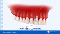 Couronne Sur Implant Dentaire-Brossard-La Prairie-St-Hubert-Longueuil-Candiac...(450) 923-7999