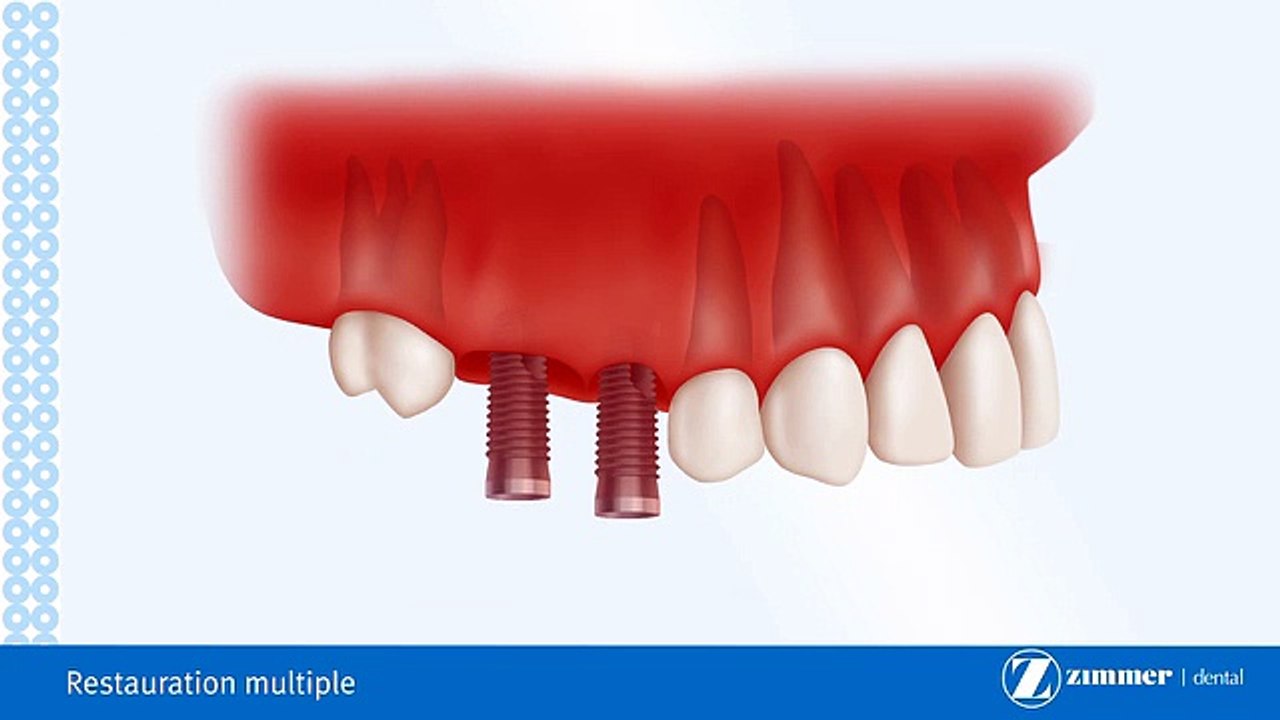 Pont Sur Implants Dentaires-Brossard-La Prairie-St-Hubert-Longueuil-Candiac...(450) 923-7999