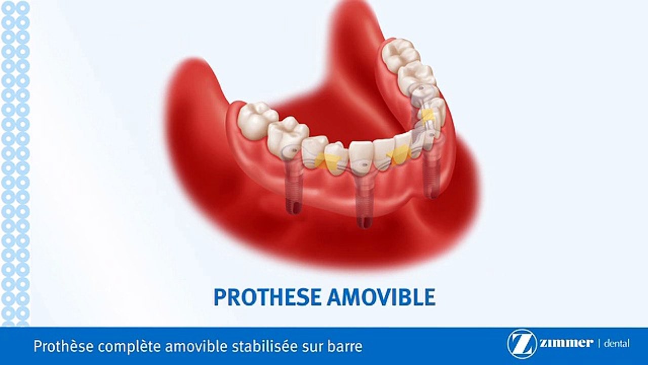Prothèse Sur Implants Amovible-Brossard-La Prairie-St-Hubert-Longueuil-Candiac...(450) 923-7999