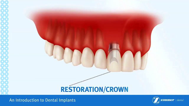 Introduction to Dental Implant Brossard-La Prairie-St-Hubert-Longueuil-Candiac...(450) 923-7999