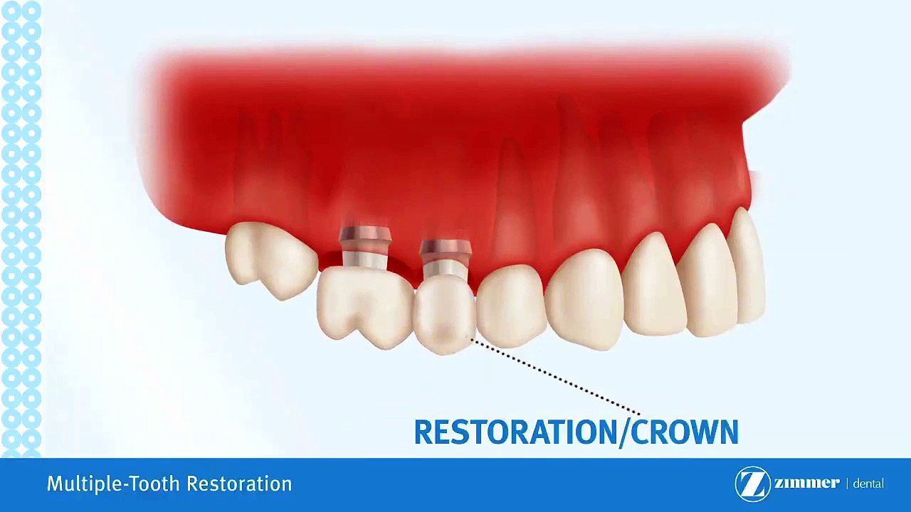 Bridge On Implants Brossard-La Prairie-St-Hubert-Longueuil-Candiac...(450) 923-7999