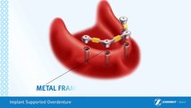 Removable Denture On Implants Brossard-La Prairie-St-Hubert-Longueuil-Candiac...(450) 923-7999