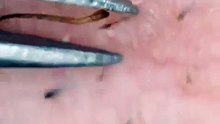 sticky Ingrown hairs refuses to be extracted