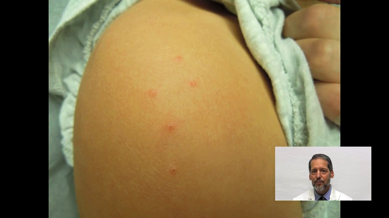 Bird Mite Infestation! Diagnosis and Treatment - OnlineDermClinic