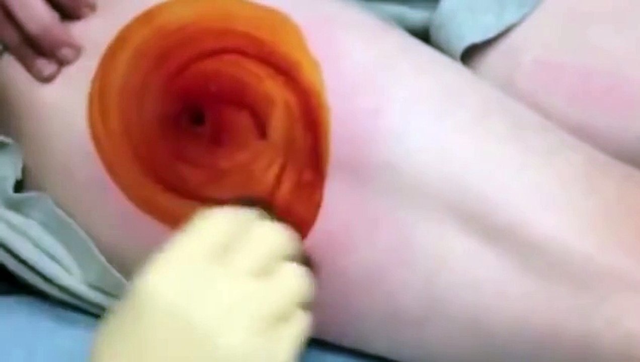 thigh abscess with drainage YouTube
