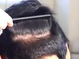 HAIR TRANSPLANT DONOR CLOSURE, TRICHOPHYTIC 3 DALLAS TEXAS