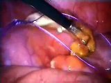 Laparoscopic Appendectomy (laparoskopik apandisit ameliyatı)