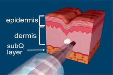 Basic Injection Techniques for Fillers