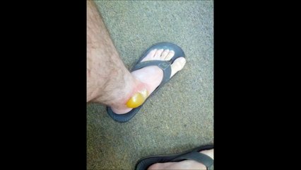 【閲覧注意】スズメバチに刺された結果
