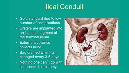 Surviving Bladder Cancer the Treatment Process Urinary Diversions