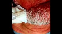 A Milia Medley, then a Dilated Pore of Winer. For medical education- NSFE.