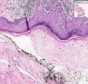 Histopathology Penis--Carcinoma in situ