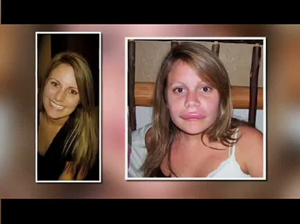 Hereditary Angioedema -  Health Alert - NAPS-TV