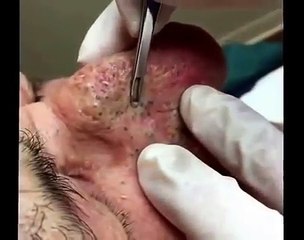 Vídeo nojento de homem espremendo cravo usando raspador vem repercutindo nas redes sociais.