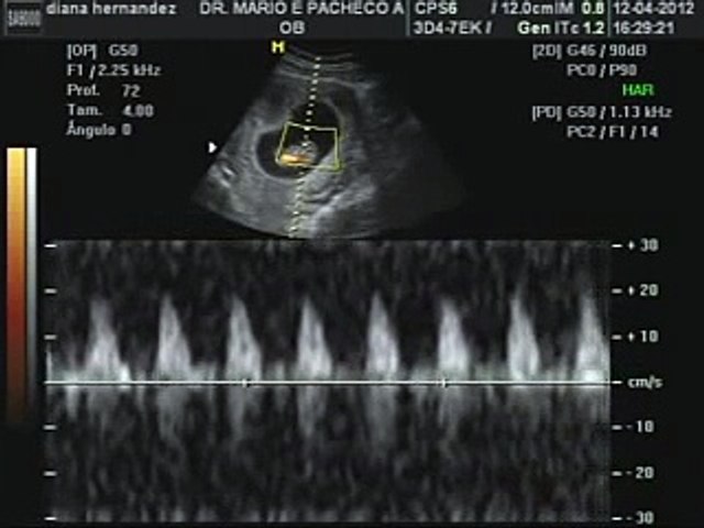 El Primer Ultrasonido De Nuestro Bebe 9 Semanas Video Dailymotion