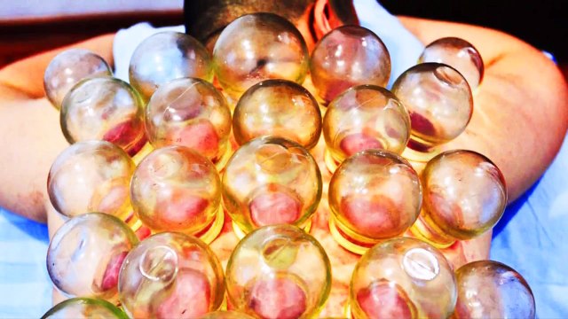 Fire Cupping; This Can't Be Real! Popping Cysts, Boils, Trypophobia, Whiteheads, & More