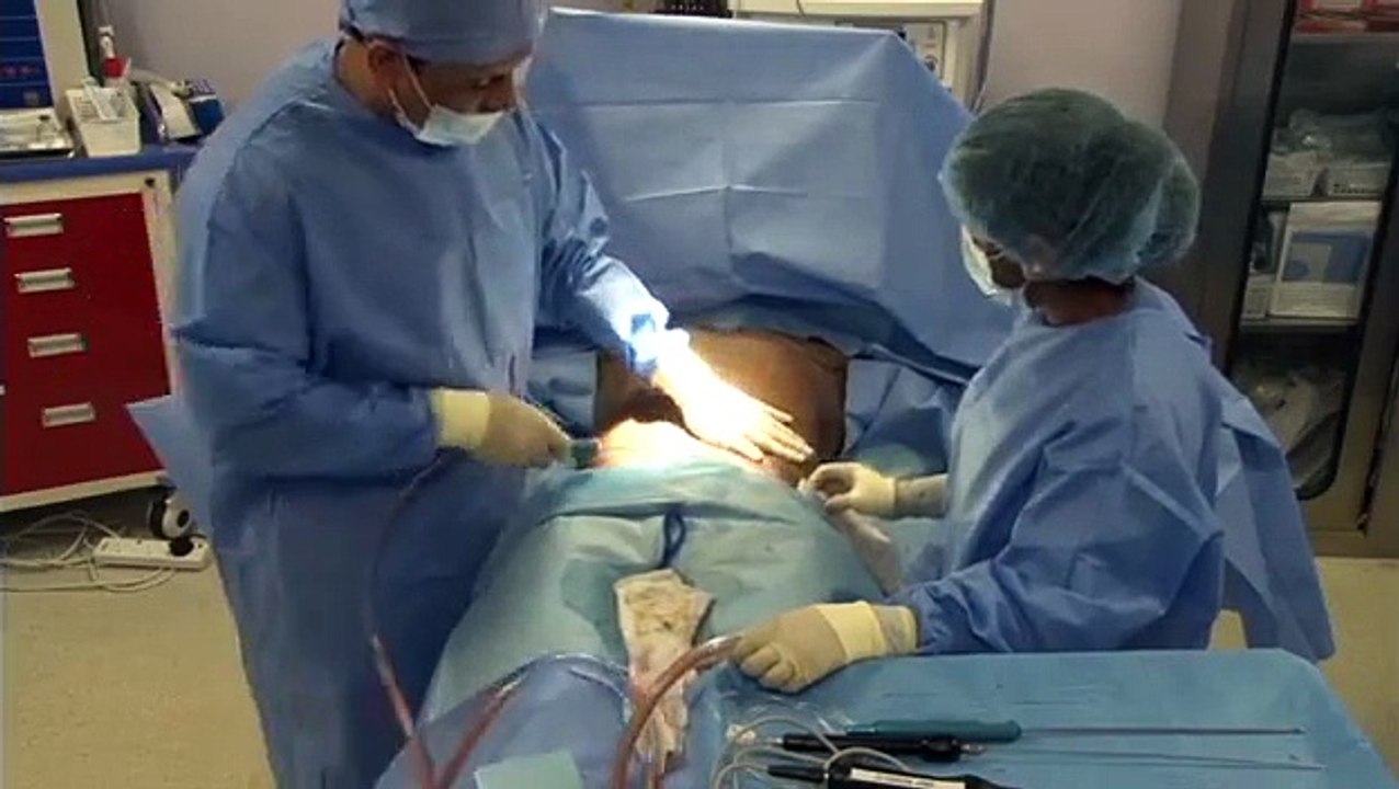 High Definition VASER Liposuction