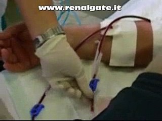 fistola per dialisi inizio dialisi
