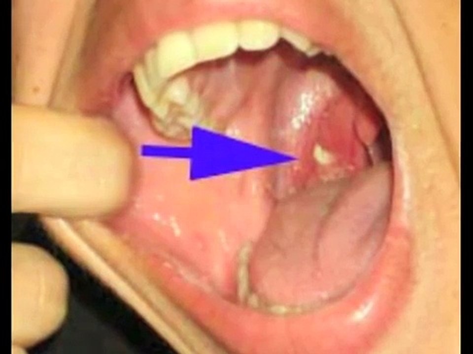 Tonsil Cryptolysis to Address Tonsil Stones