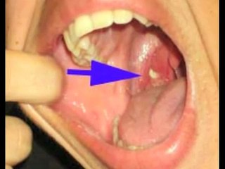 Tonsil Cryptolysis to Address Tonsil Stones