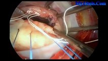 Mitral valve repair, which involved open heart surgery