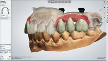 Dental System™ 2013 - Customized Abutments and Screw Retained Crowns