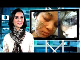 Women Grows Nails Instead Of Hair