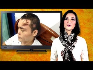 OMG! Man Grows Nose On Forehead