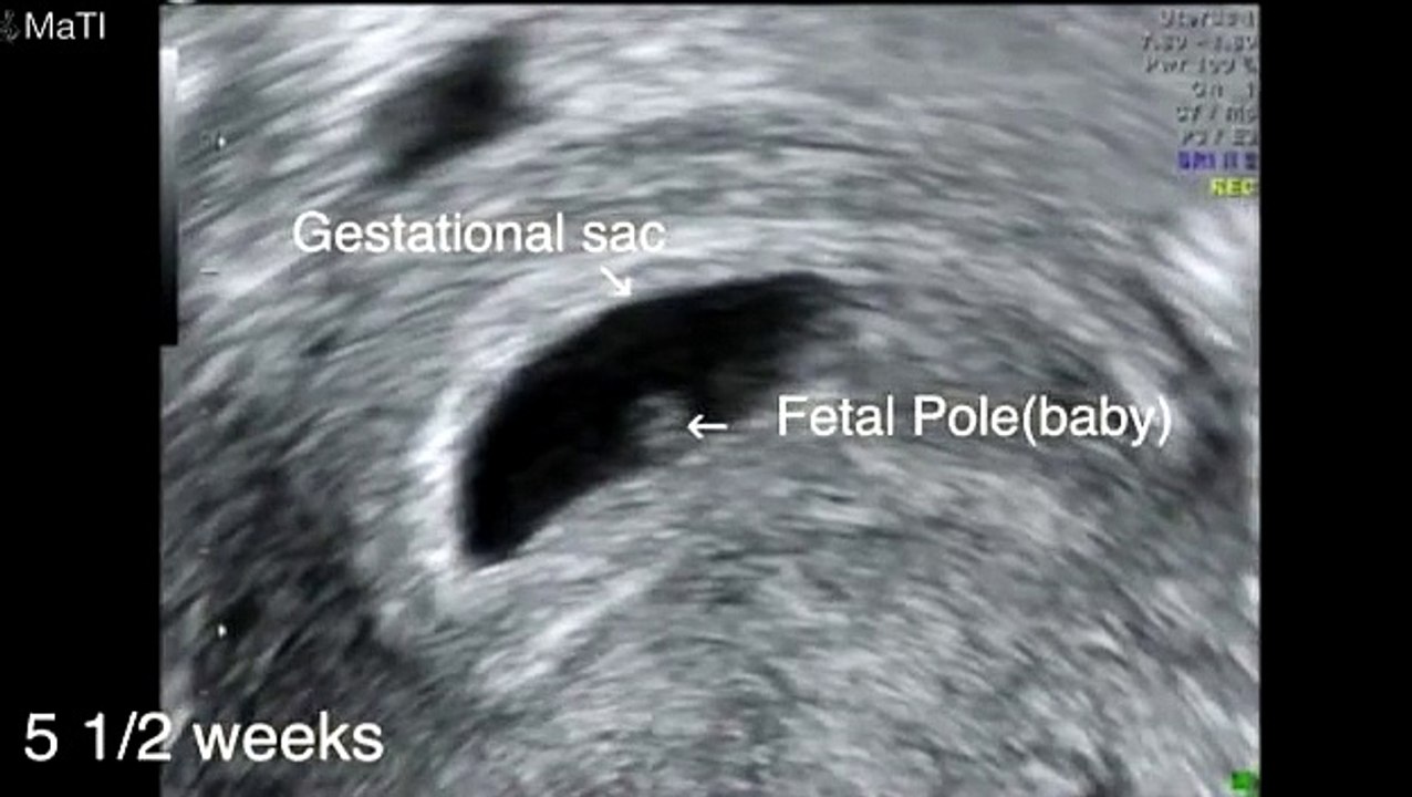 Echographie -- L'Embryon De 5 A 9 Semaines