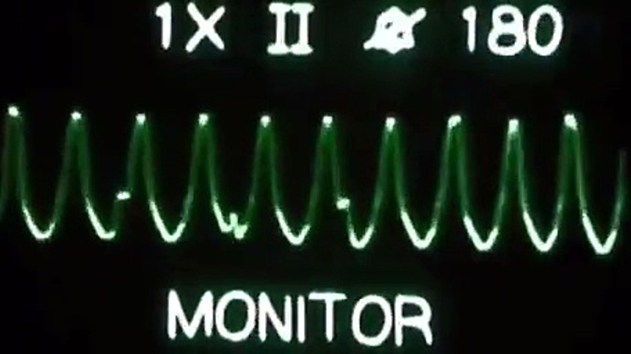 ECG/EKG - Ventricular Tachycardia Treatment