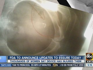 FDA to announces updates to Essure