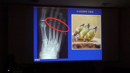 The Athlete and Metatarsalgia of the Lesser Toes - Zehava Sadka Rosenberg