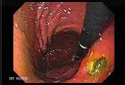 High Resolution Video Endoscopy of a Deep Gastric Ulcer