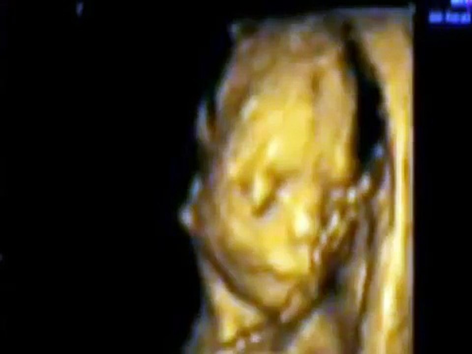 The Unborn Baby Never Stops Being A Human Being / Pro-Life Anti-Abortion Video PSA
