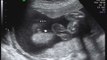24 weeks / 6 months pregnant ultrasound sonogram