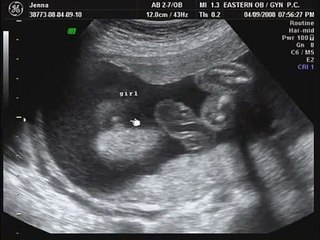 24 weeks / 6 months pregnant ultrasound sonogram