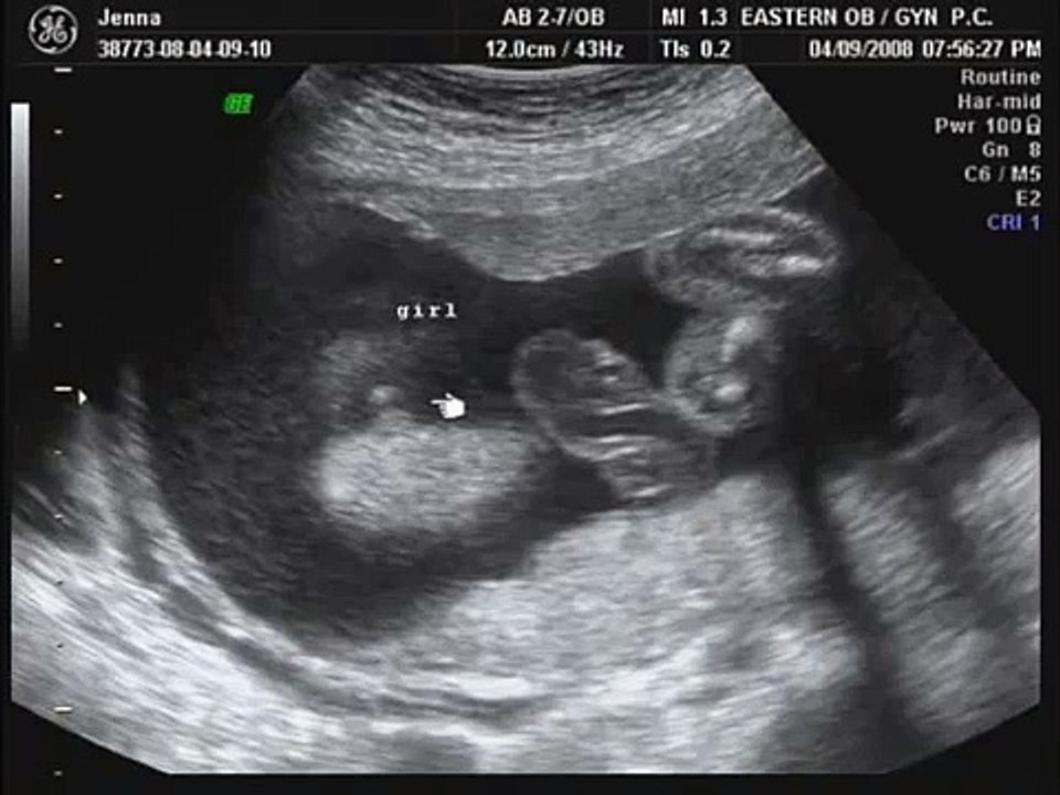24 weeks / 6 months pregnant ultrasound sonogram