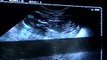 Sonogram at 16 weeks Pregnancy - Embarazo 16 semanas