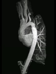 Cardiac MRI - Aorta angiogram with coarctation